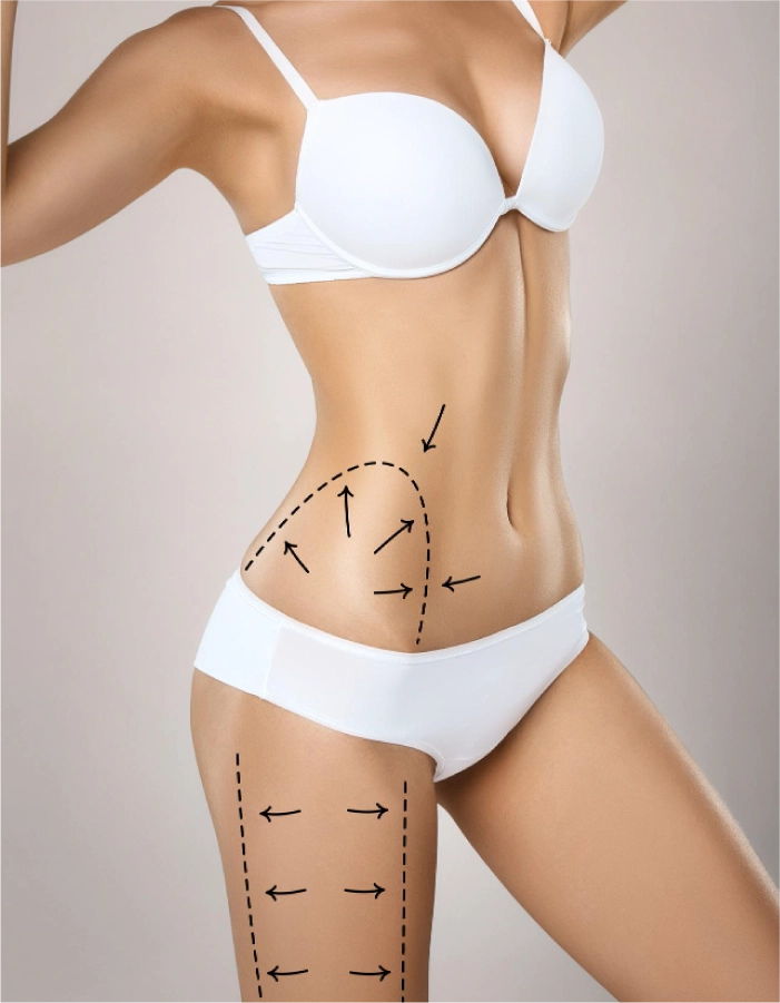 Lipoescultura – Liposucción