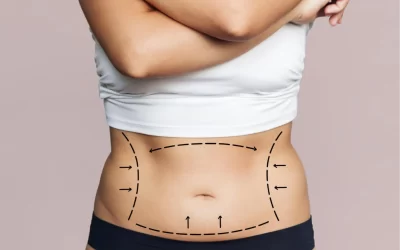 Abdominoplastia vs. Mommy Makeover postparto